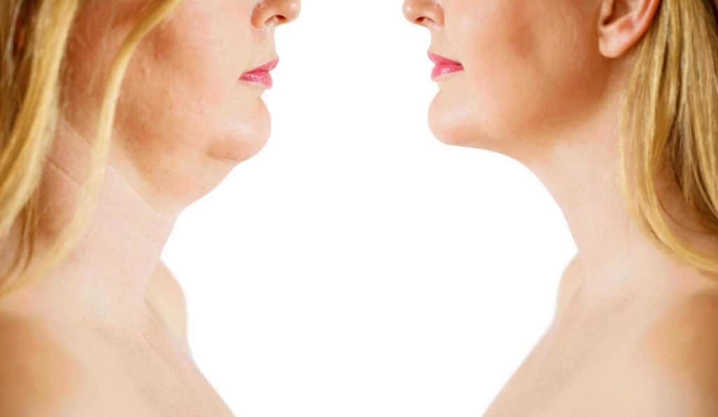 Double Chin treatment Edgware before and after results