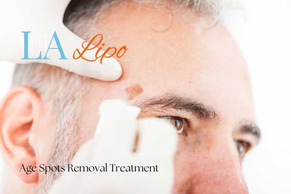 What Are the Most Effective Treatments for Age Spots Edgware?