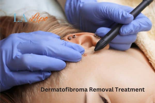 Dermatofibroma Removal Treatment Edgware