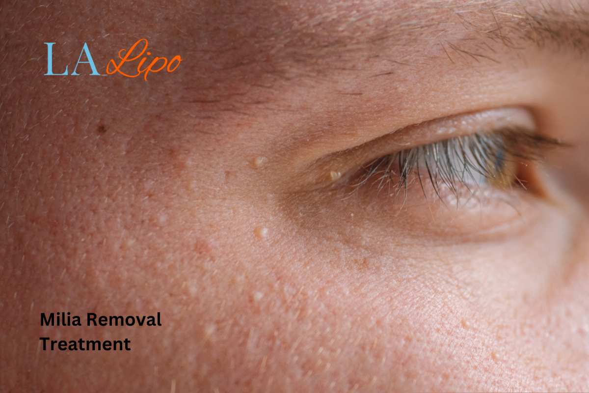 Cryopen Milia Removal: Is It the Easiest and Safest Option Edgware?