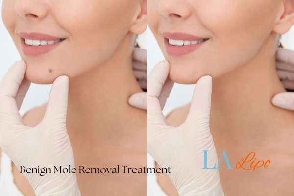 Before-and-after results following benign mole-removal treatment Edgware