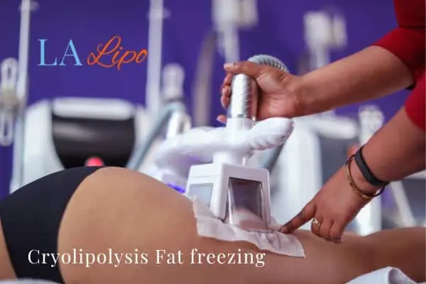 women getting fat freezing Edgware