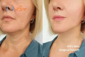 hi-fu for wrinkles Edgware before and after results