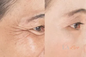 Before and after results of woman - HI-fu wrinkles reduction treatment Edgware