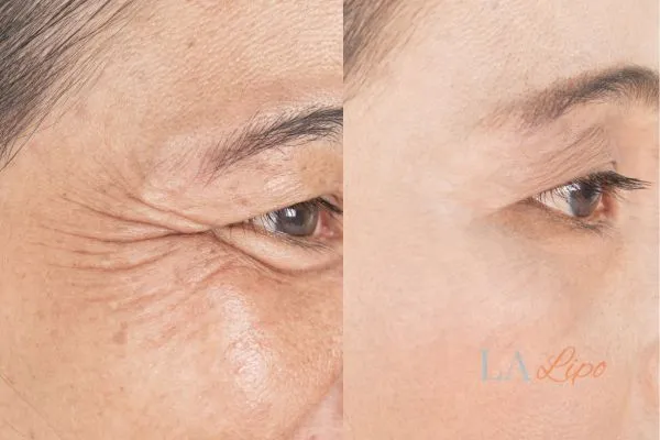 Before and after results of woman - HI-fu wrinkles reduction treatment Edgware