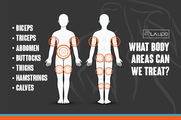 Graphic to show areas you can have LA-EMS Body Sculpting Edgware treatment.
