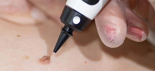 skin tag removal using cryopen Edgware