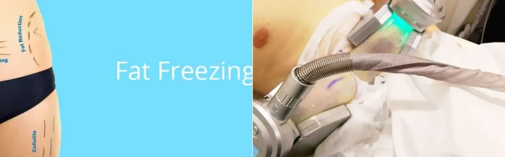 Fat freezing Edgware on multiple areas of the body