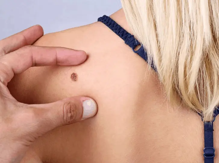 woman having mole removal Edgware consultation before treatment.