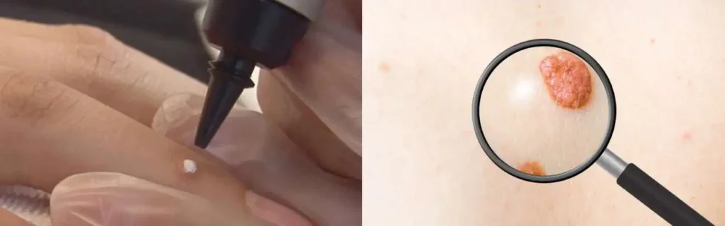 Cryopen for mole removal Edgware - speak to our team today!