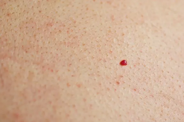 close up of a cherry angioma Edgware