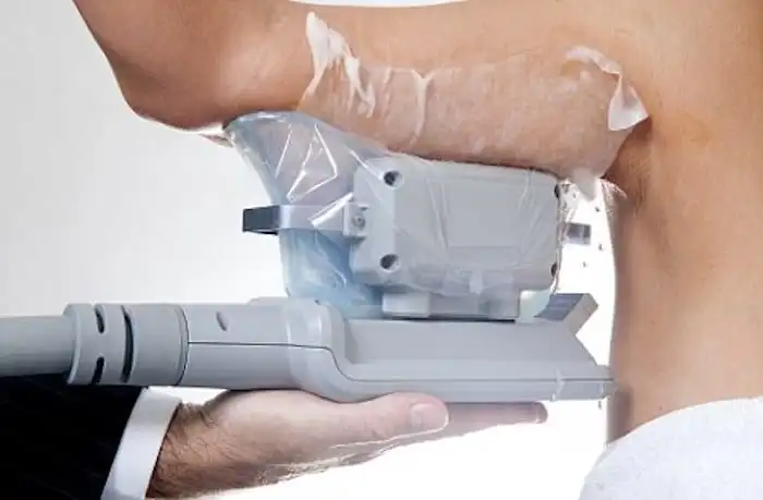 Picture of fat freezing Edgware on the upper arms.