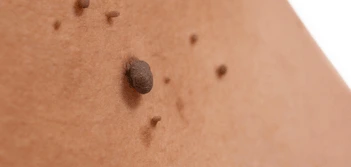 image of a skin tag Edgware