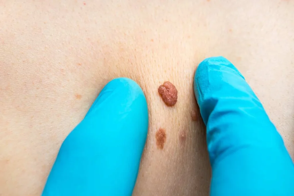 Consultant examining a skin tag Edgware