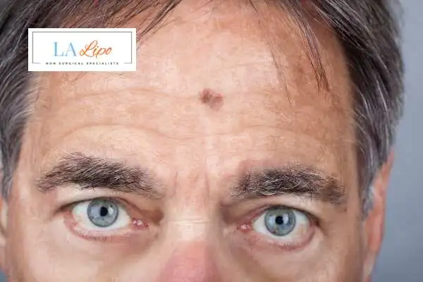 Solar Lentigo Removal Edgware image of man with mark on his forehead