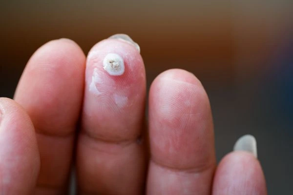 wart on person finger - cryotherapy to treat from LA LIPO Edgware