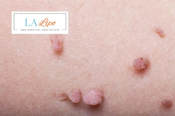 Does cryopen skin tag removal Edgware hurt? Find out now call our team today!