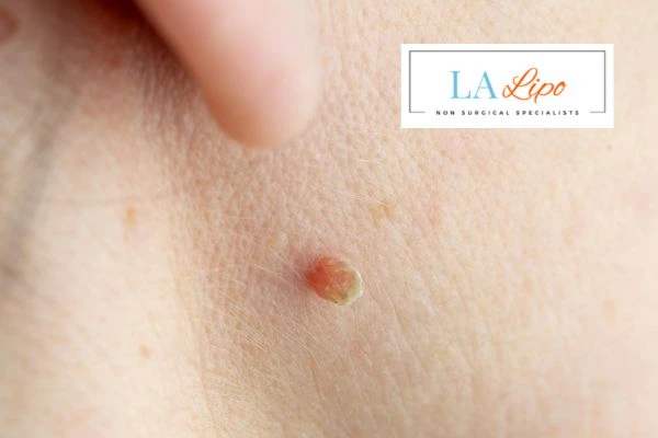 Book skin tag removal Edgware today speak to our team now!