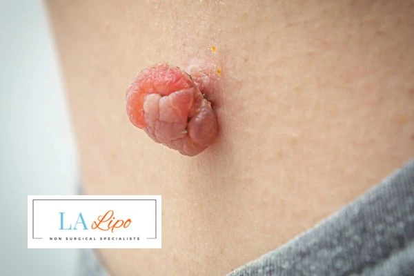 Interested in skin tag removal Edgware? Concerned about the pain? Find out more today!