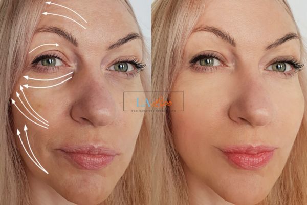 Morpheus 8 results Edgware face lift.