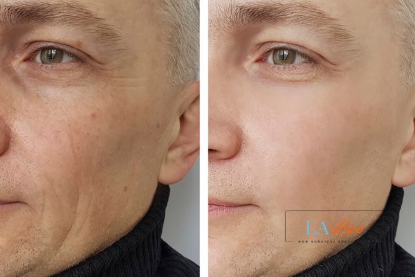 See the amazing results of Morpheus8 Treatment Edgware!