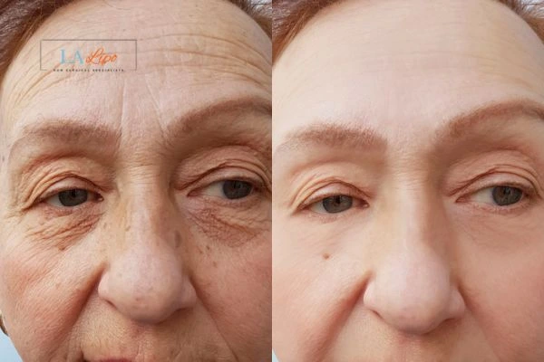 The powerful benefits of Morpheus8 Treatment Edgware - Call Our team today!