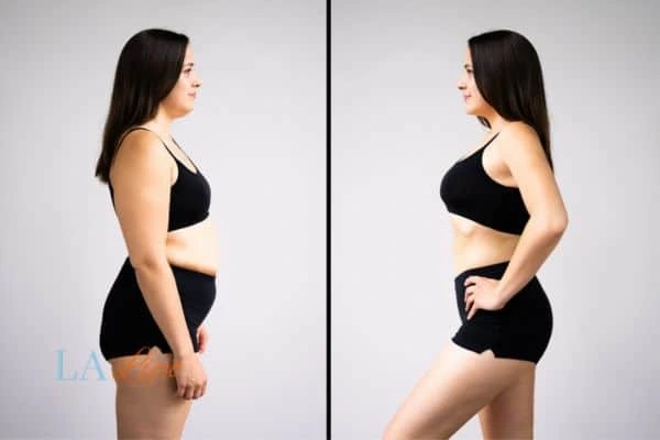 Picture of womans before and after using LA-EMS body sculpting to improve her core strength Edgware