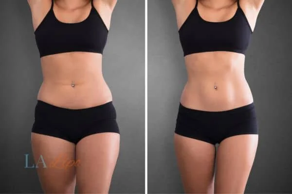 before and after results of non-surgical treatment to help a woman's body image and mental health Edgware