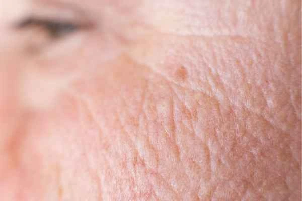close up picture of a woman's face showing an age spot Edgware