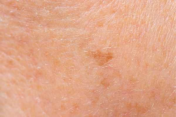 close up picture of age spots Edgware