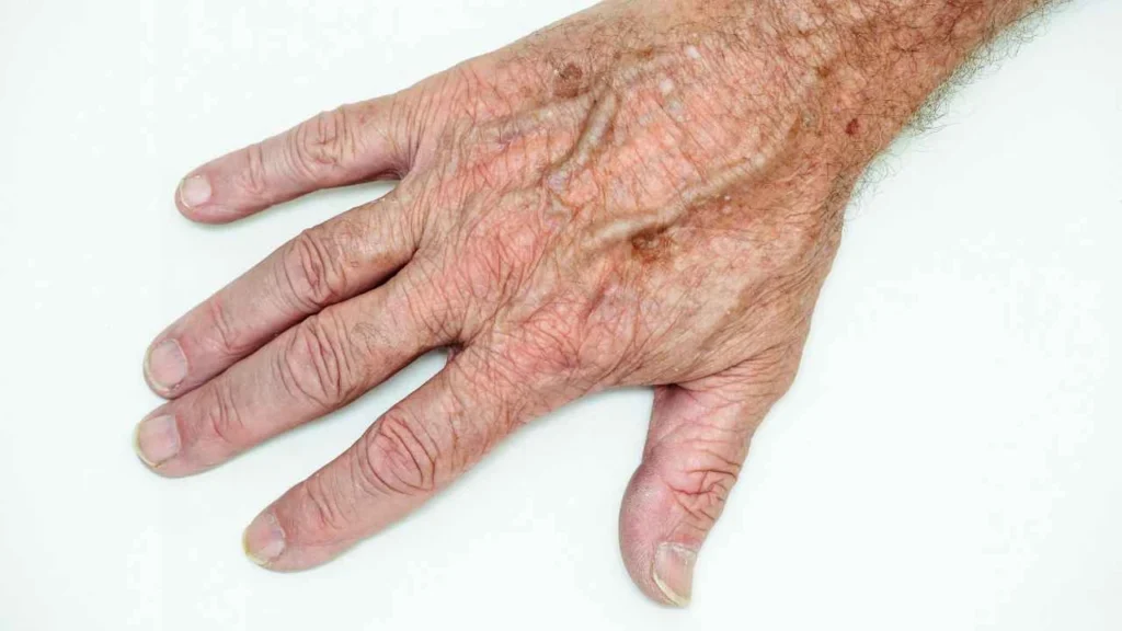 Male hand showing age spot Edgware
