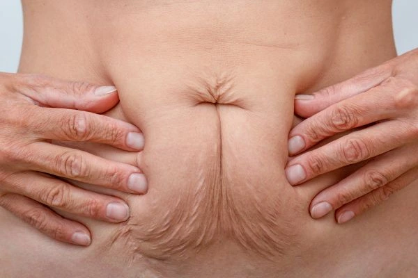 Should I Combine Diastasis Recti Treatment with Body Contouring for Better Results Edgware?