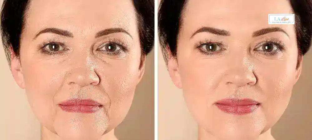 How Long Does It Take to See Results and How Long Do They Last Edgware?