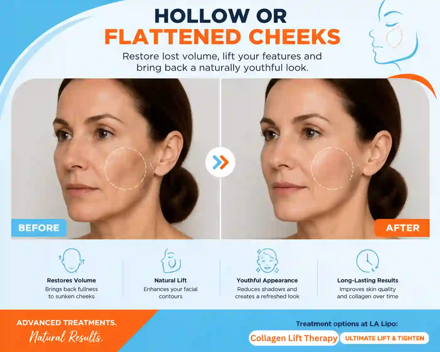 Sign #4: Hollow or Flattened Cheeks Edgware