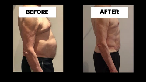 What Symptoms Can Diastasis Recti Cause in Men? Weak Core, Back Pain and Poor Posture Edgware